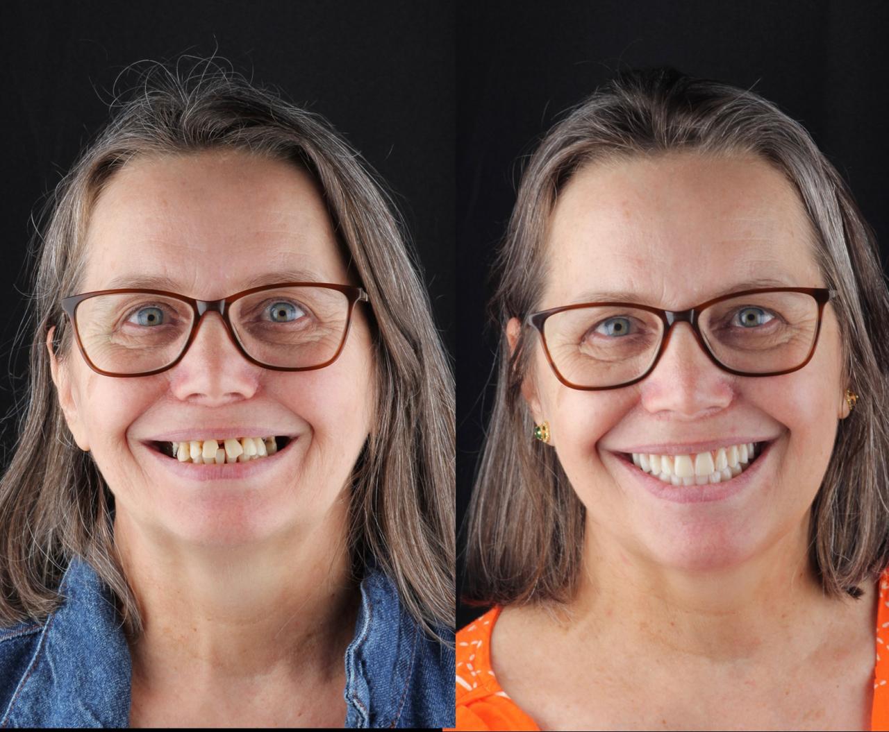 Antes e depois: reabilitação total sobre implantes