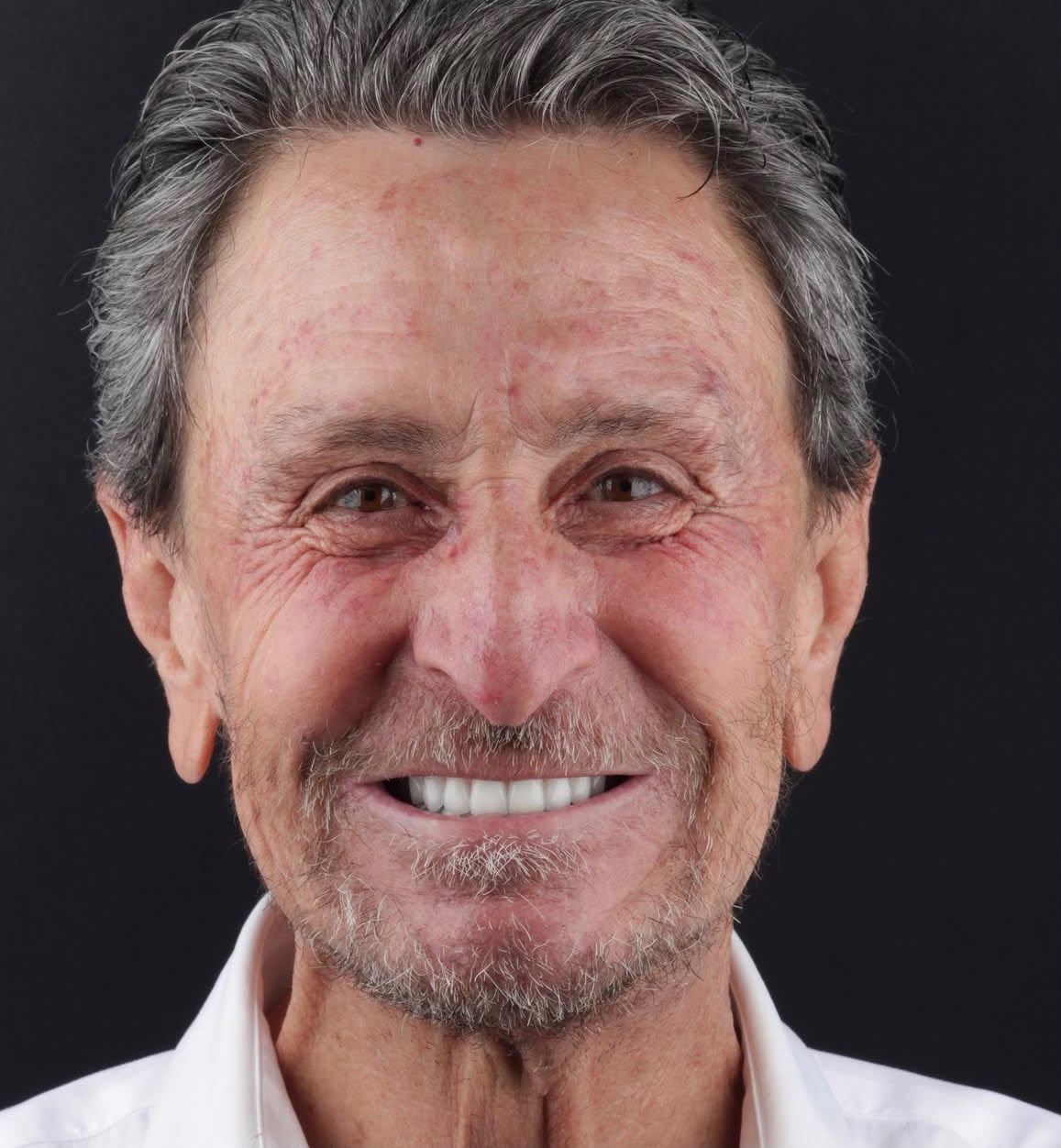 Antes e depois: reabilitação total com implantes